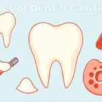 Different types of dental cavities: pit and fissure, smooth surface, and root cavities.