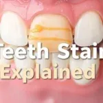 Infographic showing the difference between extrinsic and intrinsic teeth stains, including causes and treatment options.